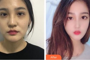 福建省立醫(yī)院整形外科鄭清健整形價(jià)格表附鼻部手術(shù)案例案例展示