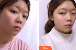 福建醫(yī)科大學(xué)附屬第二醫(yī)院眼科中心吳瑜瑜整形價(jià)格表附眼部案例展示