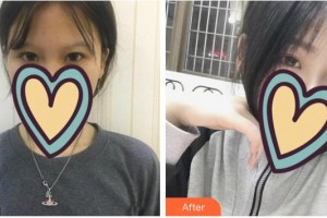 福建醫(yī)科大學(xué)附屬第二醫(yī)院眼科中心許鍛煉整形價(jià)格表附眼部綜合案例展示