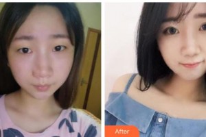 福建醫(yī)科大學(xué)附屬第二醫(yī)院眼科中心蔡幼妹整形價(jià)格表附眼部綜合案例展示