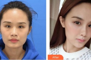 福建醫(yī)科大學(xué)附屬第二醫(yī)院眼科中心洪玉整形價(jià)格表附祛眼袋案例展示