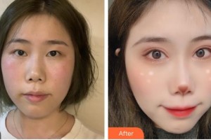 福建醫(yī)科大學(xué)附屬協(xié)和醫(yī)院整形激光美容中心陳小松整形價(jià)格表附阿爾法雙眼皮案例展示