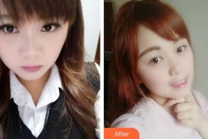 福建醫(yī)科大學(xué)附屬口腔醫(yī)院張端強(qiáng)整形價(jià)格表附牙齒隱形矯正案例展示