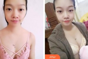 福州臺(tái)江醫(yī)院整形美容中心王炳整形價(jià)格表附豐胸案例展示