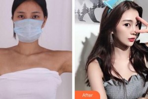 福州臺(tái)江醫(yī)院整形美容中心孫森整形價(jià)格表附假體隆胸案例展示