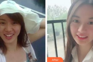 福州莎菲琳(弘宇)整形美容醫(yī)院林婷整形價(jià)格表附牙綜合案例展示