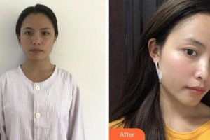 福州海峽美容醫(yī)院曹海峰整形價(jià)格表附面部吸脂案例展示