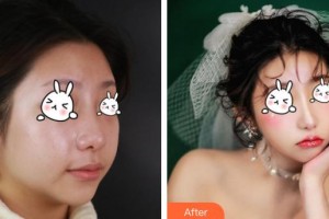 福州華仁醫(yī)療整形美容醫(yī)院劉宏整形價(jià)格表附創(chuàng)可貼面部吸脂瘦臉術(shù)案例展示