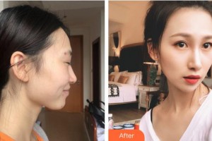 福州愛美爾整形美容醫(yī)院范德厚整形價(jià)格表附下頜角顴骨顴弓外板案例展示