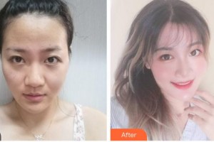 福州市第八人民醫(yī)院整形美容科許金玲整形價(jià)格表附發(fā)際線種植案例展示