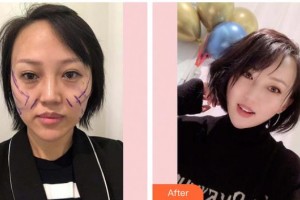 福州愛美爾整形美容醫(yī)院邱富美整形價(jià)格表附抗初老熱瑪吉案例展示