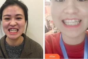 福州美貝爾醫(yī)療美容門診部石曾領(lǐng)整形價(jià)格表附隱形牙齒矯正案例展示