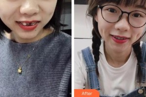 福州美萊華美美容醫(yī)院陳涵整形價(jià)格表附缺牙妹妹變形記案例展示