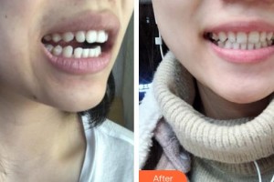 福州愛思特比華利整形美容醫(yī)院強(qiáng)副主任 主診醫(yī)師整形價(jià)格表附牙齒矯正案例展示