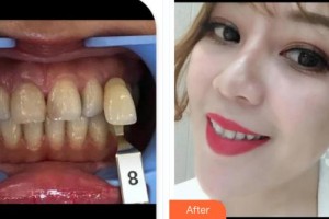 福州美萊華美美容醫(yī)院黃思遠(yuǎn)整形價(jià)格表附牙齒美白案例展示