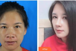 福州海峽美容醫(yī)院李信鋒整形價(jià)格表附鼻部手術(shù)案例展示