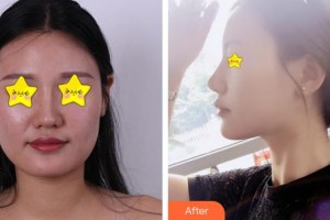 福州優(yōu)美醫(yī)療美容診所袁宇綱整形價(jià)格表附假體隆下頜案例展示