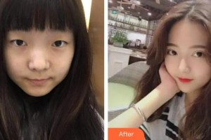 福州美萊華美美容醫(yī)院王燦整形價(jià)格表附切開雙眼皮案例展示