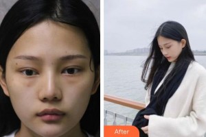 福州中聯(lián)美康整形美容醫(yī)院林琳整形價(jià)格表附內(nèi)切祛眼袋案例展示