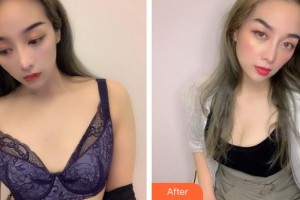 福州隆美爾整形美容醫(yī)院郭志輝 整形價(jià)格表附假體豐胸案例展示