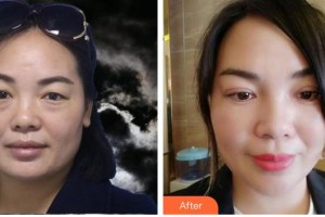 福州海峽美容醫(yī)院陳藝清整形價(jià)格表附不開刀雙眼皮案例展示