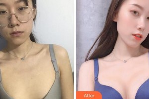 福州市鼓樓醫(yī)院整形美容中心朱金祥整形價(jià)格表附自體脂肪豐胸案例展示