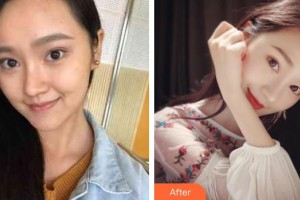 福州藝美醫(yī)療整形美容診所郭秀清整形價(jià)格表附多方面部埋線提升-埋線提升提升案例展示