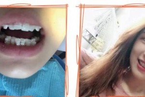 福州海峽美容醫(yī)院柳書喻整形價(jià)格表附隱形托槽矯正案例展示