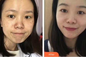 福州海峽美容醫(yī)院張光澤整形價(jià)格表附超激光美膚祛斑案例展示