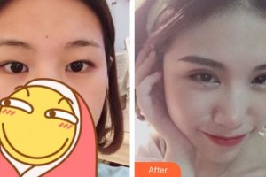 福州優(yōu)美醫(yī)療美容診所吳長(zhǎng)飛整形價(jià)格表附雙眼皮案例展示