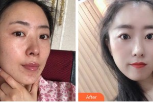 福州愛美爾整形美容醫(yī)院魏芳整形價格表附激光美膚激光案例展示