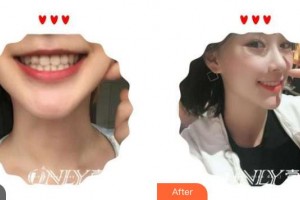 福州海峽美容醫(yī)院鄭純整形價格表附牙齒美白貼面案例展示