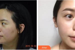 福州美萊華美美容醫(yī)院黃劍媚整形價格表附緊膚抗衰案例展示