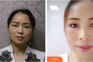 福州中聯(lián)美康整形美容醫(yī)院蔡群整形價格表附切開雙眼皮案例展示