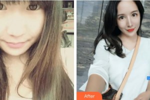 福州臺江醫(yī)院整形美容中心李海英整形價格表附鼻部整形案例展示