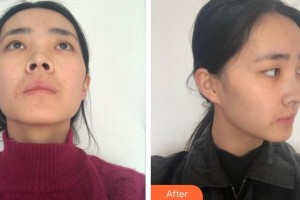 福州名韓整形美容醫(yī)院光整形價格表附鼻部手術(shù)案例展示