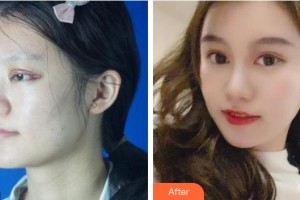 福州中聯(lián)美康整形美容醫(yī)院黃恒平整形價格表附下頜角肥大案例展示