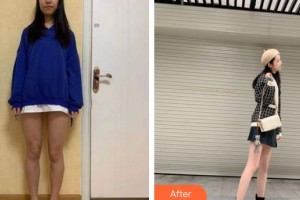 福州臺江醫(yī)院整形美容中心金永圭整形價格表附大腿吸脂案例展示