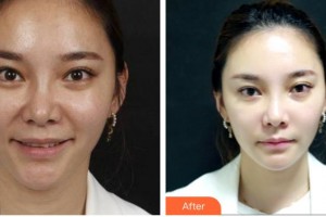 福州臺江醫(yī)院整形美容中心蕭長雄整形價格表附抗衰案例展示