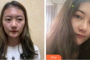 福州隆美爾整形美容醫(yī)院張履興整形價格表附鼻部綜合案例展示