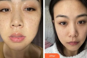 福州曙光整形美容醫(yī)院任海英整形價格表附超激光美膚祛斑案例展示