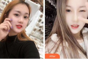 福州愛思特比華利整形美容醫(yī)院劉耀美整形價格表附眼部手術(shù)案例展示