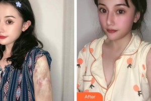 福州市第一醫(yī)院整形美容科朱立群整形價格表附燙傷疤痕案例展示