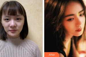 福州中意醫(yī)療美容門診部金成基整形價格表附肋軟骨隆鼻案例展示