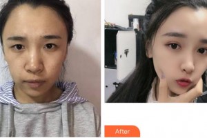 福州莎菲琳(弘宇)整形美容醫(yī)院雷雪華整形價(jià)格表附眼部綜合案例展示