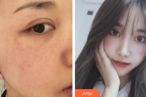 福州市第一醫(yī)院整形美容科鄒丹整形價(jià)格表附超激光美膚祛斑案例展示