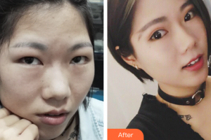 廣州尚美善造美容醫(yī)院邱健整形價(jià)格表附切開雙眼皮案例展示