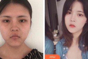 福州美萊華美美容醫(yī)院曾德朋整形價(jià)格表附埋線提升案例展示