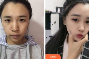 福州秀清醫(yī)療美容診所周鎮(zhèn)龍整形價(jià)格表附眼部整形案例展示