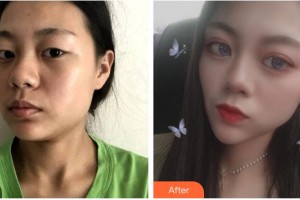 福州臺(tái)江醫(yī)院整形美容中心馬美洲整形價(jià)格表附眼部綜合案例展示